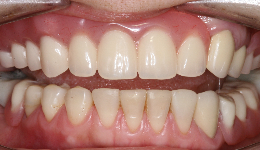 Composite Bonding, Porcelain Crowns & new Dentures (Result)	